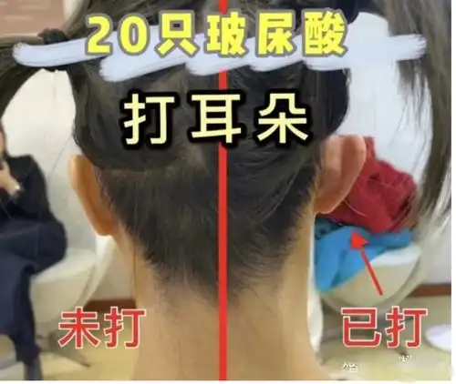 零下30度滑雪穿内衣,耳朵整容一次花5万,网红圈真的是卷生卷死
