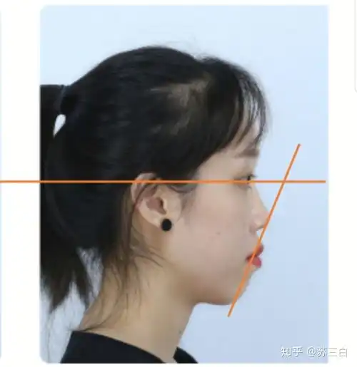 骨性嘴凸,牙齿矫正,上海口腔病防治院
